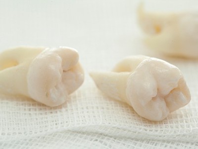 智齒疼了，這牙非拔不可嗎？