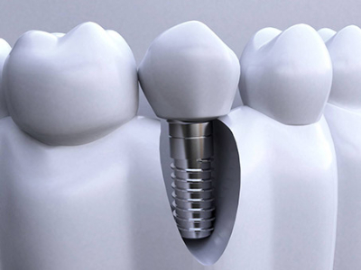 承德種植牙價格表，2024種植牙多少錢一顆呢?