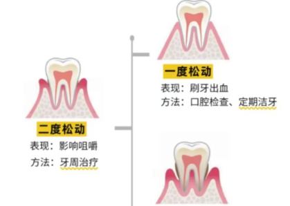 老年人牙齒松動(dòng)了要怎么辦？