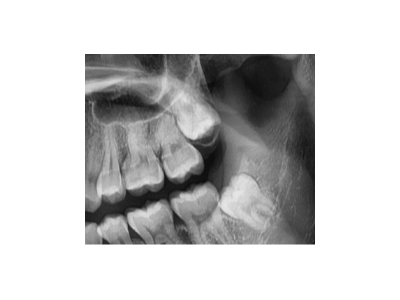 既然「智齒」不宜久留，為什么不能一次性拔掉？