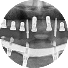 CAD/CAM義齒制作實現(xiàn)即刻修復