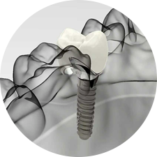 術前研究、模擬提升種植成功率