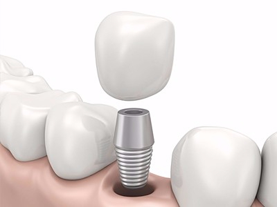 在承德哪家口腔醫(yī)院口腔種植齒好一點，惟德口腔醫(yī)院值得您的選擇