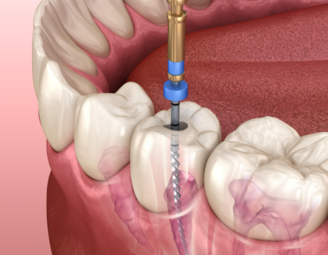 根管治療后的注意事項有哪些？